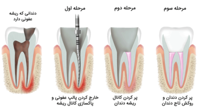 درمان دندان