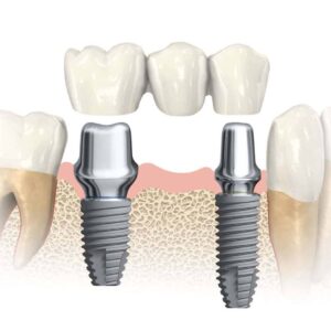 انواع ایمپلنت دندان