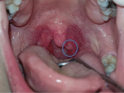 درمان زگیل تناسلی دهانی یا HPV در شیراز (اچ پی وی)