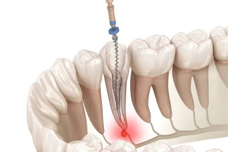 reendo scaled 1 مجله دندان پزشکی 5 دکتر نجمه یزدانی جهرمی | کلینیک دندانپزشکی شیراز