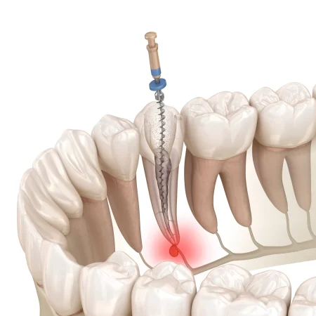 reendo scaled 1 صفحه اصلی 10 دکتر نجمه یزدانی جهرمی | کلینیک دندانپزشکی شیراز