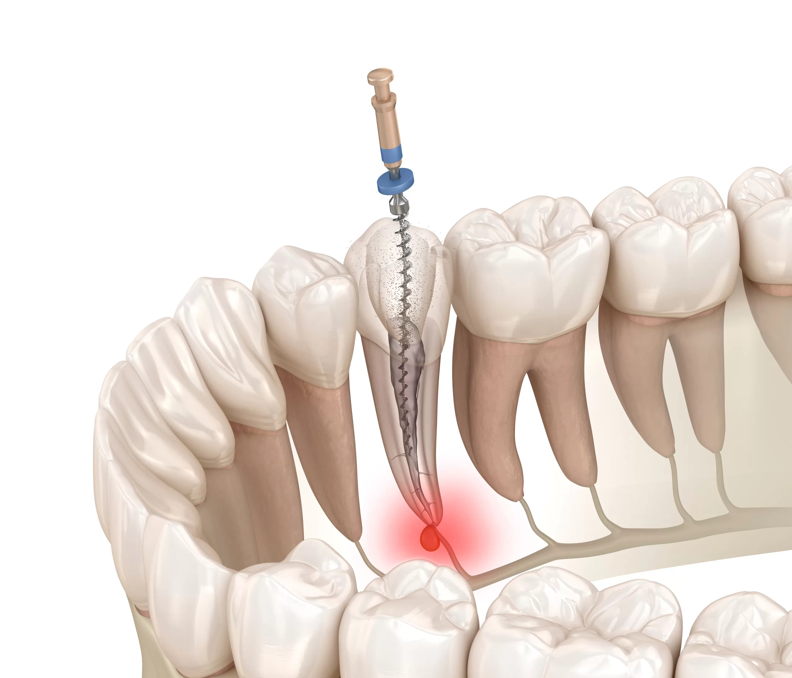 reendo scaled 1 ری اندو یا عصب کشی مجدد چیست؟ 1 دکتر نجمه یزدانی جهرمی | کلینیک دندانپزشکی شیراز